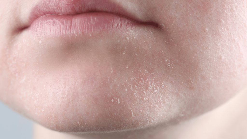 Resequedad facial en invierno por falta de colágeno y biotina.